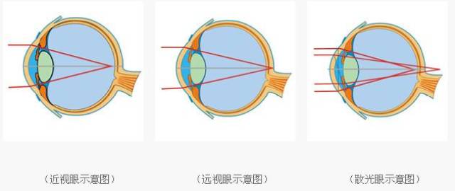 为什么近视200度的还不如400度的看得清?利瞳视力提升