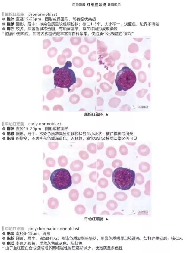 【延伸阅读】 骨髓细胞形态·正常 典型狼疮细胞(lec) 典型的狼疮