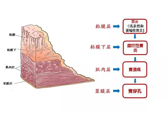 胃病如果不重视不治疗,胃粘膜会不断受损,从粘膜表层到肌肉层甚至浆膜