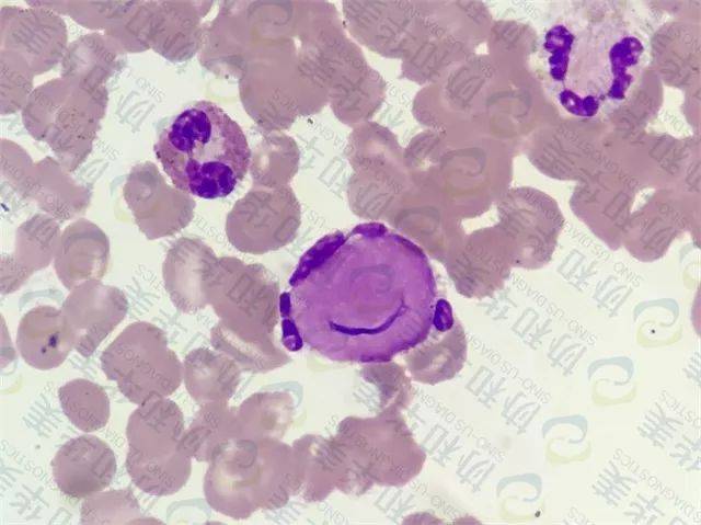 【延伸阅读】 骨髓细胞形态·正常 典型狼疮细胞(lec) 典型的狼疮