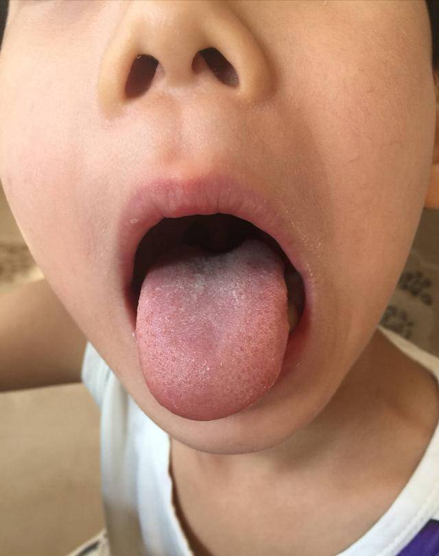 小儿舌苔厚,口臭,看小朋友一周内的舌苔变化
