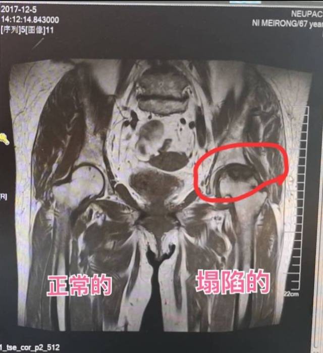 在八,九年前摔了一跤 没想到,就这么一摔 股骨头坏死  倪阿姨mri 照理