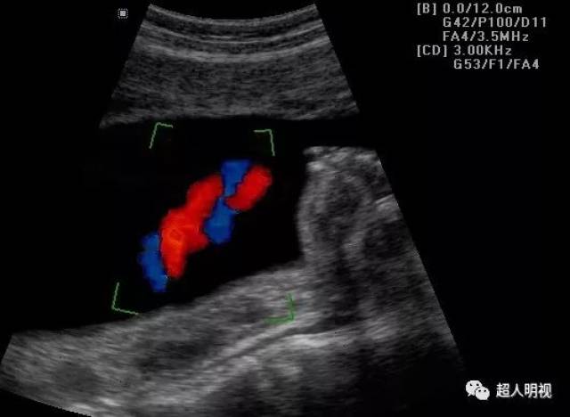 脐动脉s/d增高不一定是胎儿缺氧