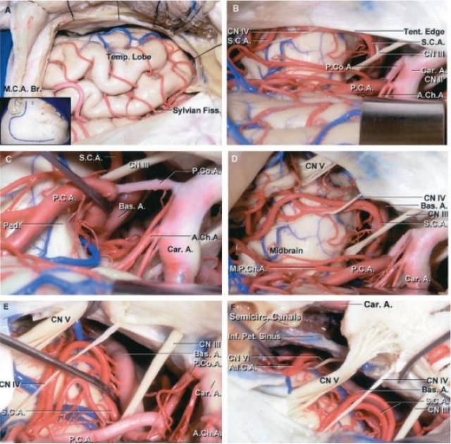 基底动脉动脉瘤:颞下入路的手术策略与技巧 | the neurosurgical