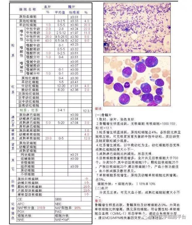 骨髓报告如下