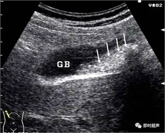 gb:胆囊     皱褶胆囊伴胆囊泥沙样结石的超声声像图 小箭头示胆囊