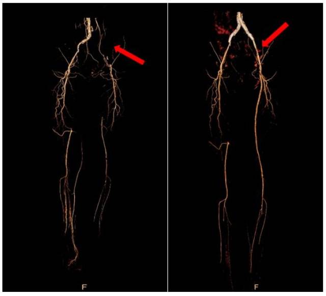 术前(左图)及术后(右图)双下肢动脉cta