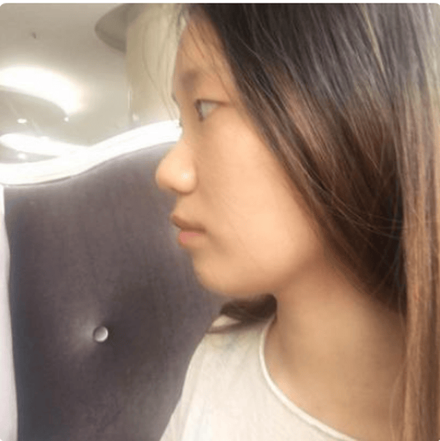 韩泰无痕双眼皮恢复后沉迷于皮皮虾不可自拔的