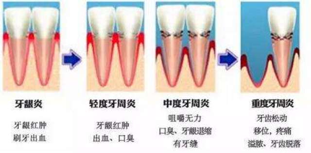 牙龈炎和牙周炎,一字之差的事儿,你怎么看?