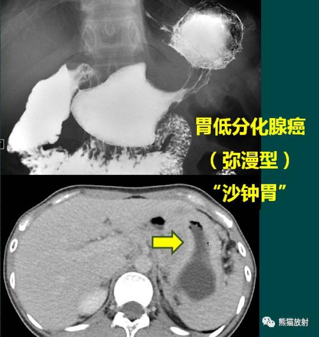 什么是胃癌的指压迹征,裂隙征,环堤征,半月征,袖口征,肩胛征?