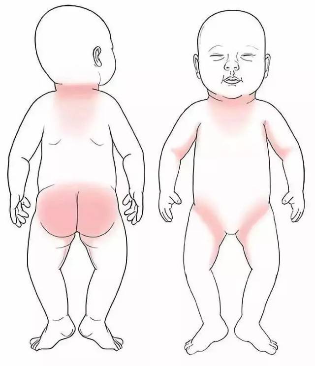 我们把痱子和湿疹放一起直观对比,这样是不是更清楚了呢