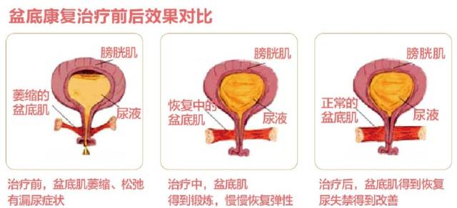 产后康复 | 生完宝宝,一定要及时修复盆底肌!