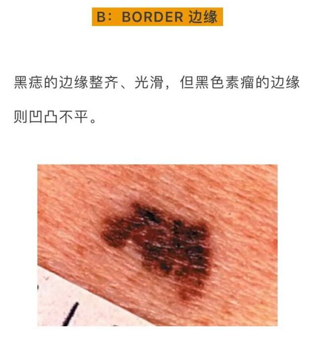 发展都有一个过程 及早干预及早切除 就能防止转变为恶性黑瘤的可能