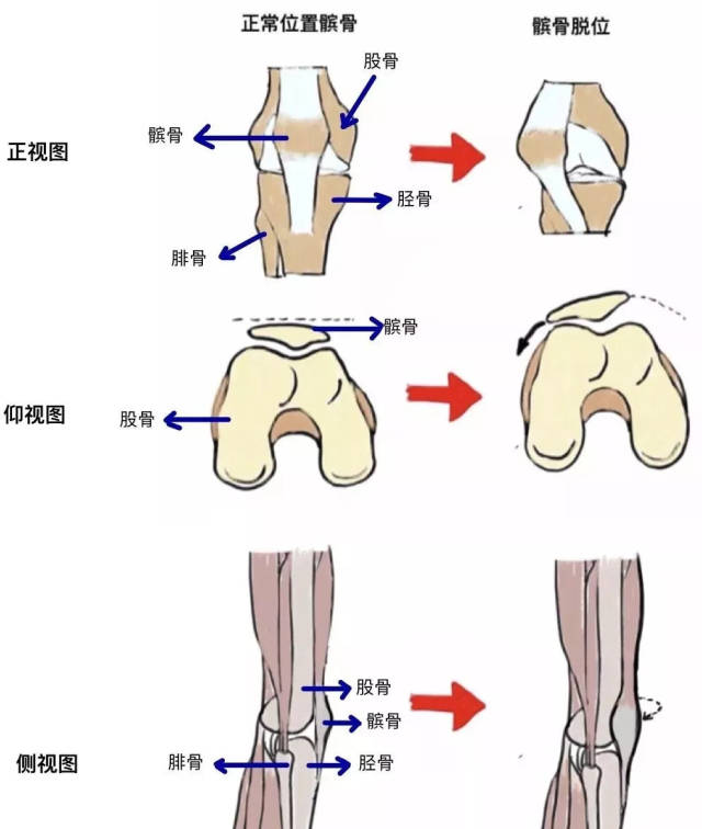 首先来看下髌骨的正常位置以及脱位的示意图