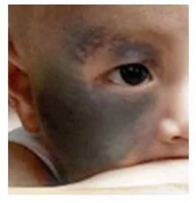 太田痣一般长在脸上,呈灰蓝色,黑蓝色,褐青色的斑片,大多在出生时或