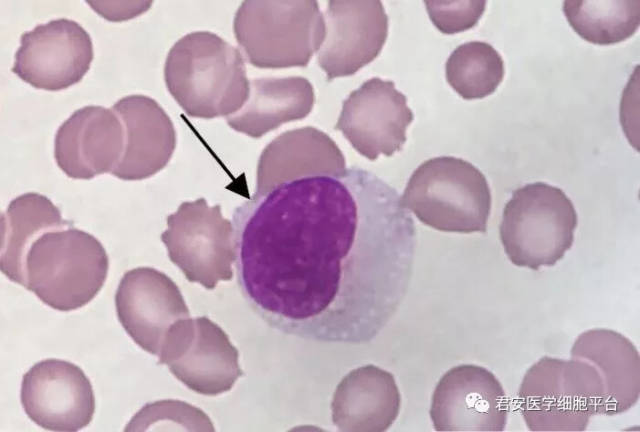 (骨髓涂片) 2018210 请报告箭头所指细胞的名称 (末梢血涂片)