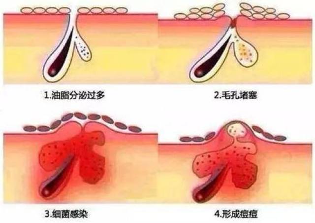 2,内分泌紊乱人体中的内分泌发生了紊乱,主要是雄性激素分泌的增加