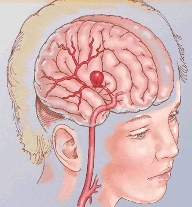 蛛网膜下腔出血的常见原因是什么?