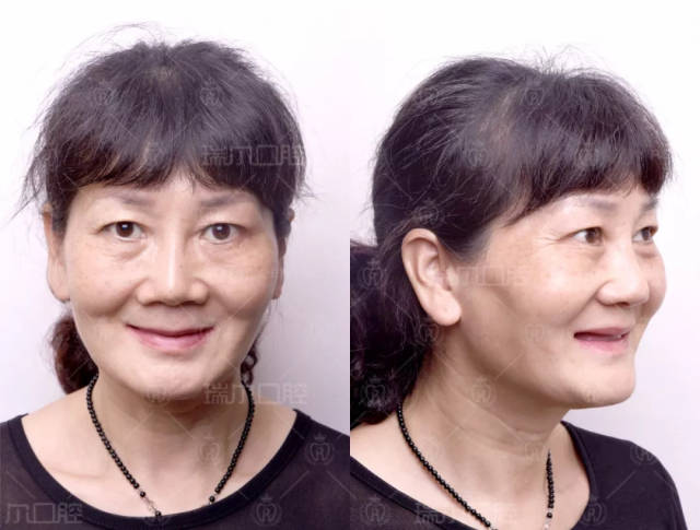 瑞尔老友记|实说牙还让人年轻?爱美龚阿姨种植用事话的干部a阿姨组工情趣做图片