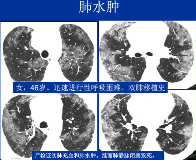 不同类型肺水肿的ct表现