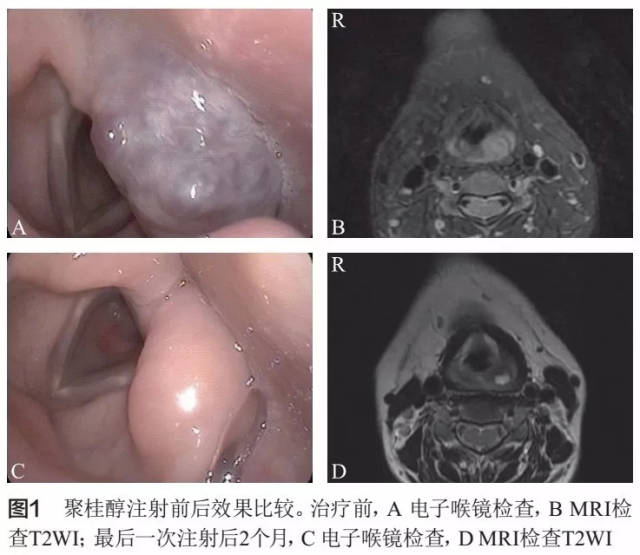 予以拔除气管套管,现已经随访4个月,双侧披裂水肿已基本消退,未见复发