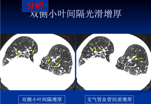 不同类型肺水肿的ct表现