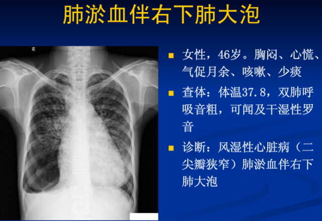 不同类型肺水肿的ct表现