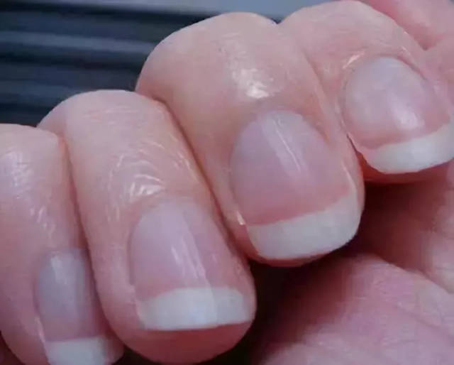 指甲有白点是缺锌缺钙?