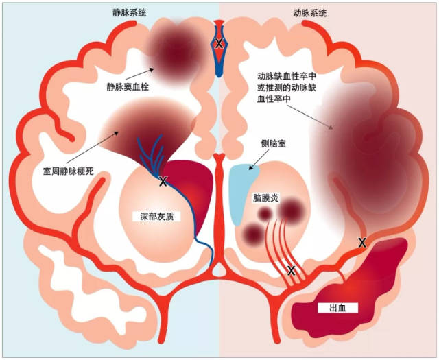 医周丨六类围生期脑卒中的识别,处理和预后