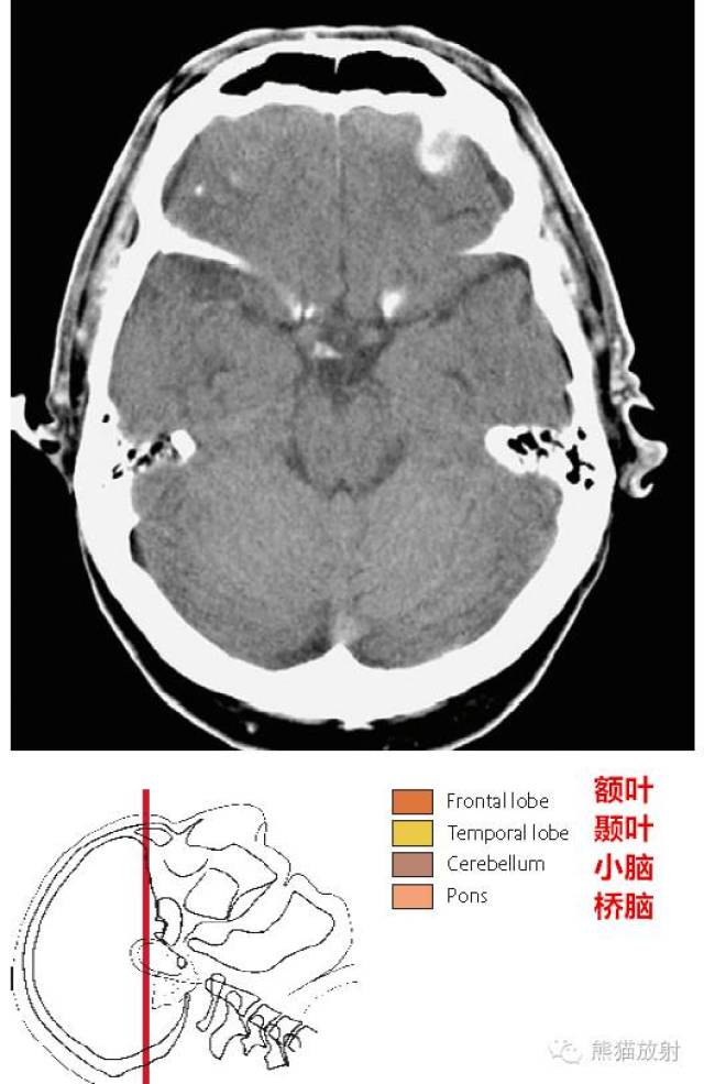 【解剖入门】颅脑ct断层(中英文对照)