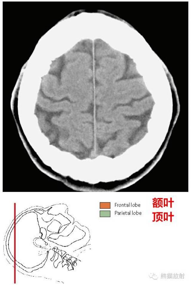 【解剖入门】颅脑ct断层(中英文对照)