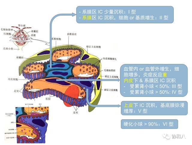 和 iv 在系膜区和毛细血管袢内皮下区都可见 ic,炎症反应强,肾小球