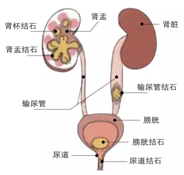 这些固体的聚集物统称泌尿系结石,在泌尿系统中哪个部位出现了结石就