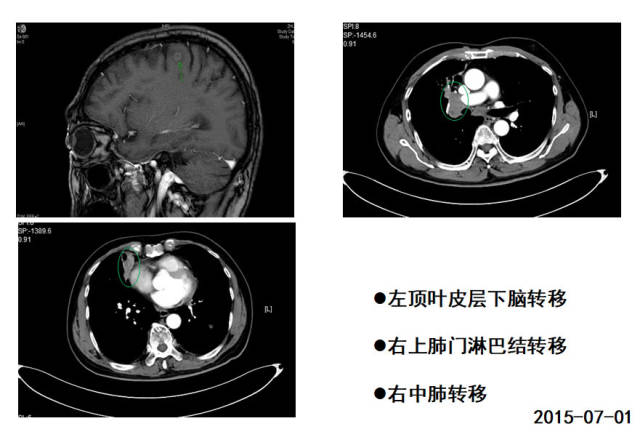 14个月的时间,转移癌细胞消失了大半,有图有真相!