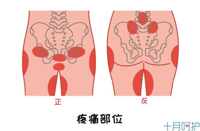 生娃后,骨盆中的耻骨分离若是迟迟无法恢复到原位,并且疼痛难忍,严重