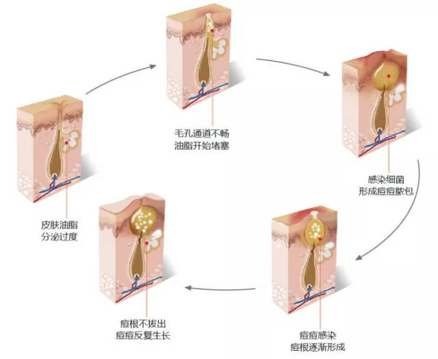 并且肌肤的角质层隆起,油脂堵塞毛孔,隆起的顶点会变成黑黑的颜色.