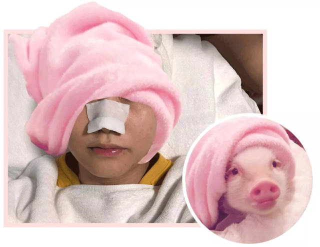 78块钱的医美项目,居然真的能去黑头!