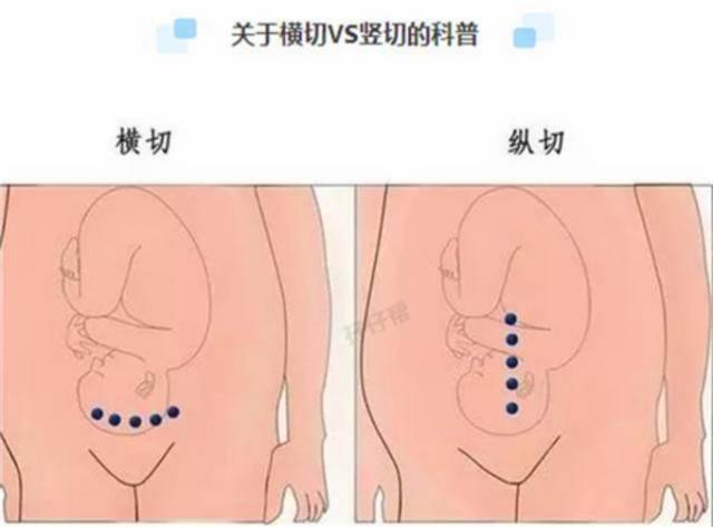 所有双胎妈妈必须接受的残酷真相:剖腹产分娩