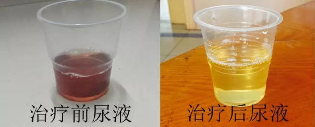 热1℃ | 永康这个小孩尿液居然呈酱油色!原因是