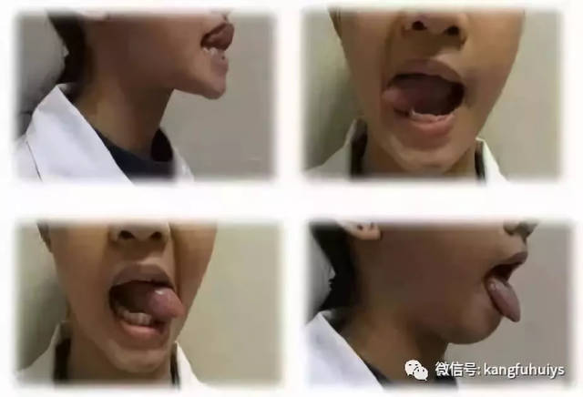 5)用压舌板与舌头做各个方向的抗阻运动,维持5秒,重复10次.