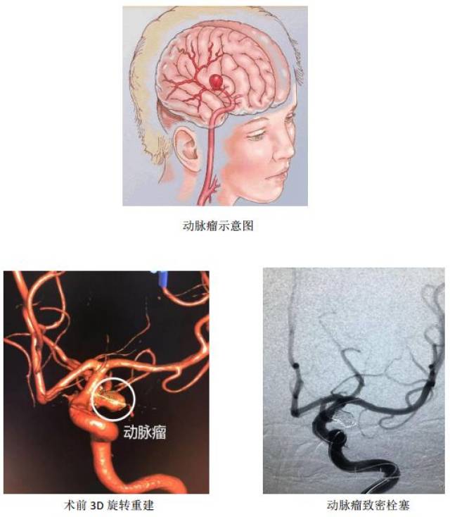 高龄老人颅内大动脉瘤微创介入手术化险为夷