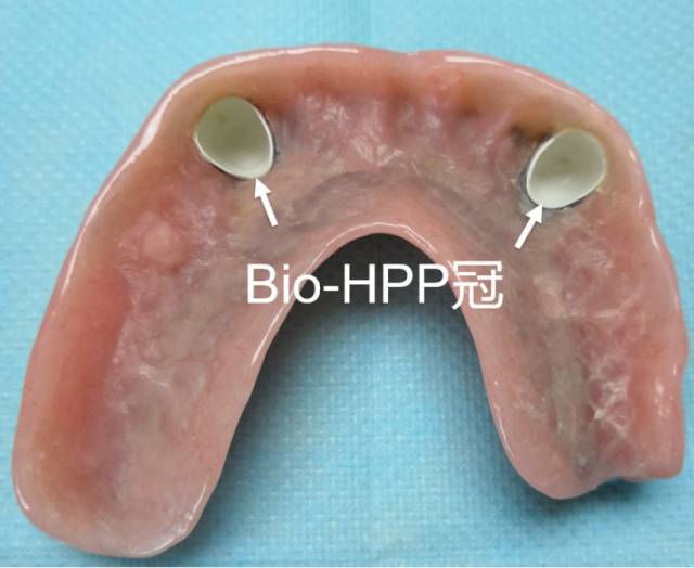 精准印取出模型,而后为刘先生量身定做bio-hpp三层冠义齿,最后粘固