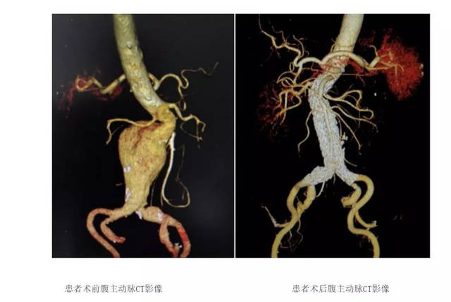 湘雅二医院血管外科巧"开窗","腹主动脉瘤"老人平安愈