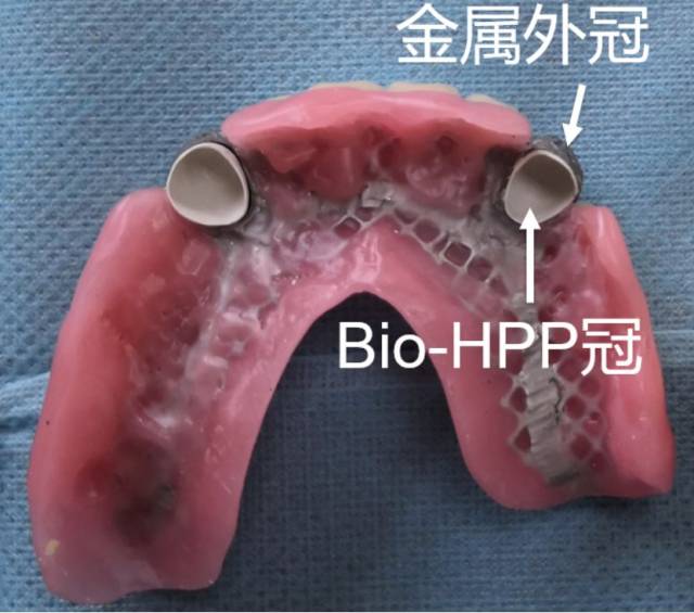 精准印取出模型,而后为刘先生量身定做bio-hpp三层冠义齿,最后粘固