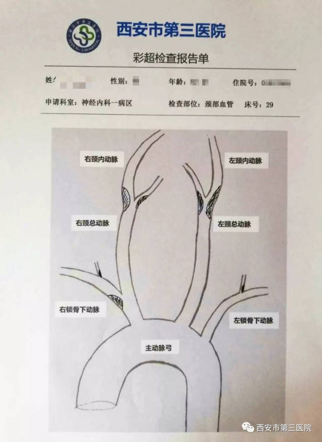 【一目了然】我的颈部血管超声报告!