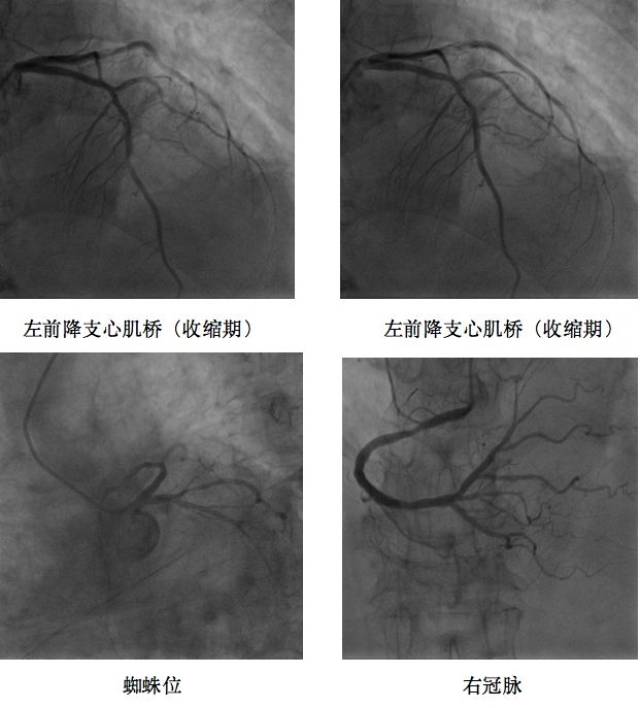 冠状动脉造影结果