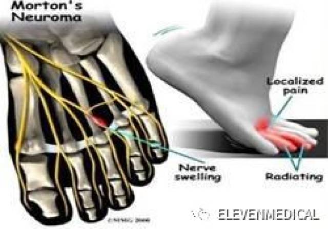 案例分享morton氏神经瘤与跖痛症
