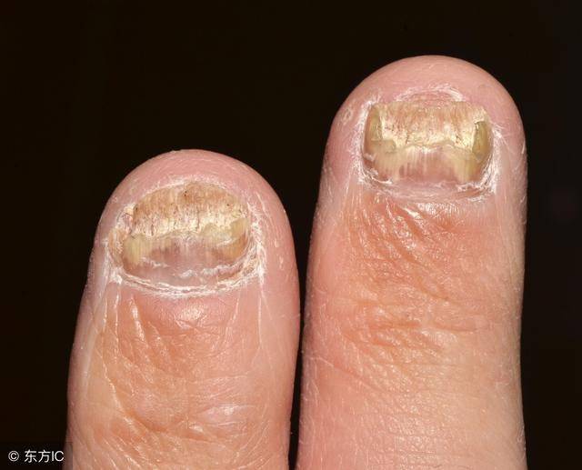 专家称:并不是所有的指甲病都是灰指甲_手机搜狐网