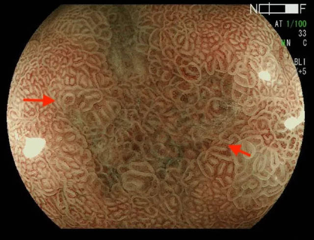 barrett食管癌显示不规则的粘膜模式(non-pit type)