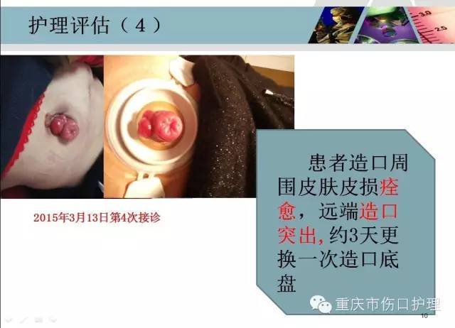 造口袋底盘渗漏患者的护理